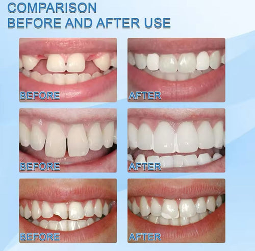 FALSE TEETH™- RESINA DENTAL, SONRISA PERFECTA😁