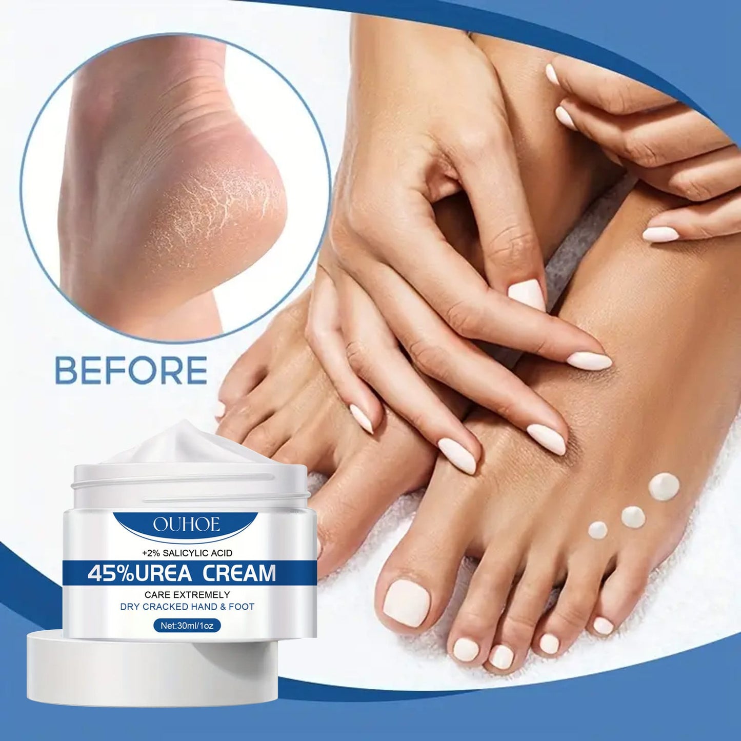 UREA CREAM™ -  CREMA PARA TALONES AGRIETADOS ⭐⭐⭐⭐⭐